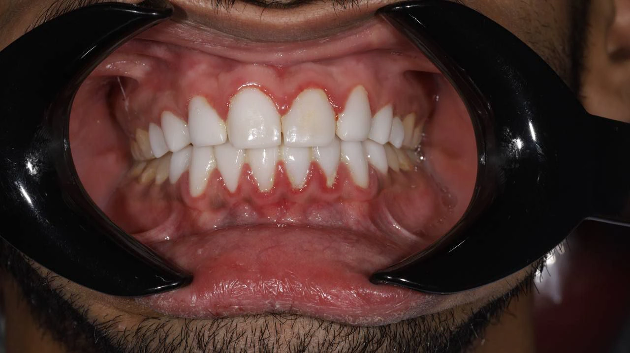 Smile Rehabilitation with New Ceramic Veneers