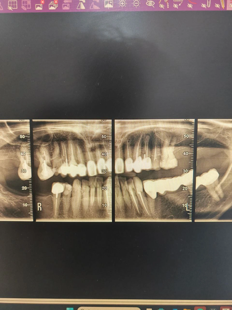 Full-Mouth Rehabilitation with Dental Implants and Fixed Prosthesis
