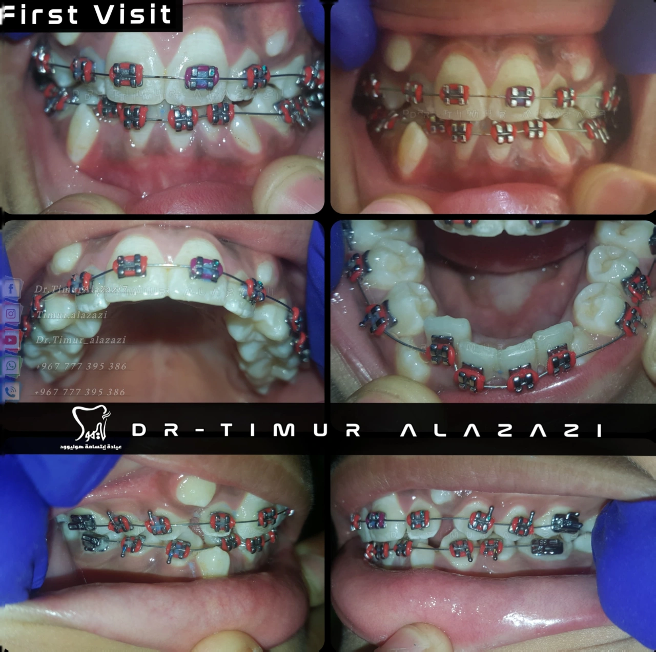 Management of Class I malocclusion with Ectopic Erupted Canines
