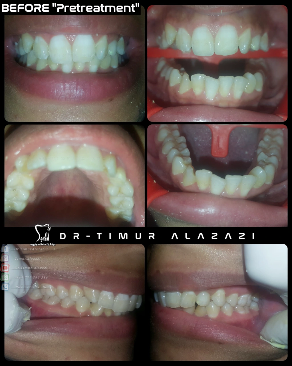 Class I malocclusion with Impacted Canine